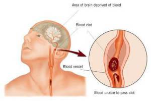 stroke-chart stroke-chart